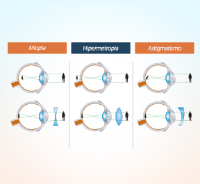 A diferença entre miopia, hipermetropia e astigmatismo