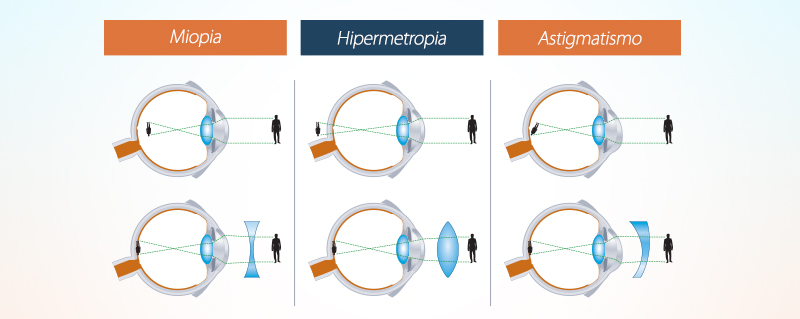 Clinica Bolzan Oftalmologia - Blog - A diferenca entre miopia, hipermetropia e astigmatismo