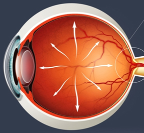 O que é Glaucoma?