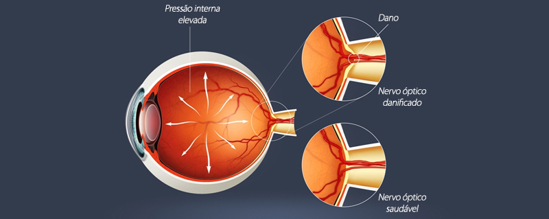 Clinica Bolzan Oftalmologia - Blog - O que e Glaucoma